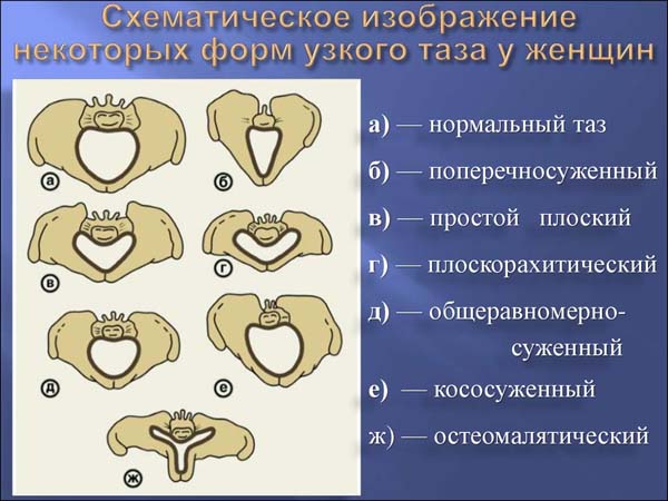 Узкий таз при беременности фото